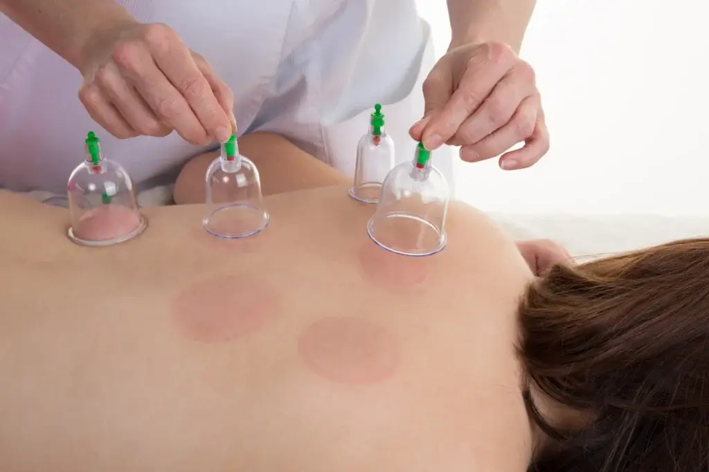 cupping therapy